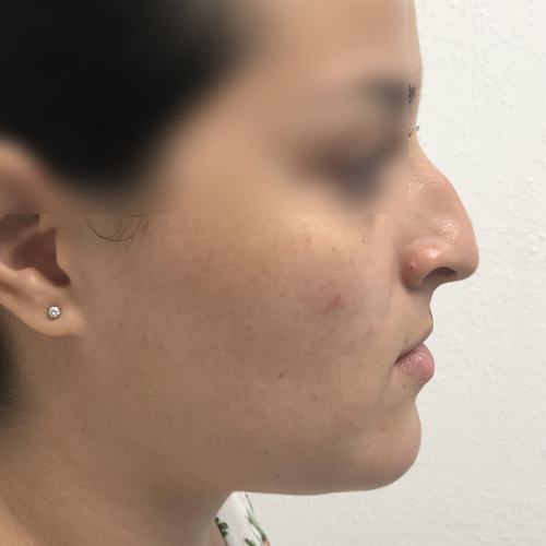 highprofile rinoplastia antes 1