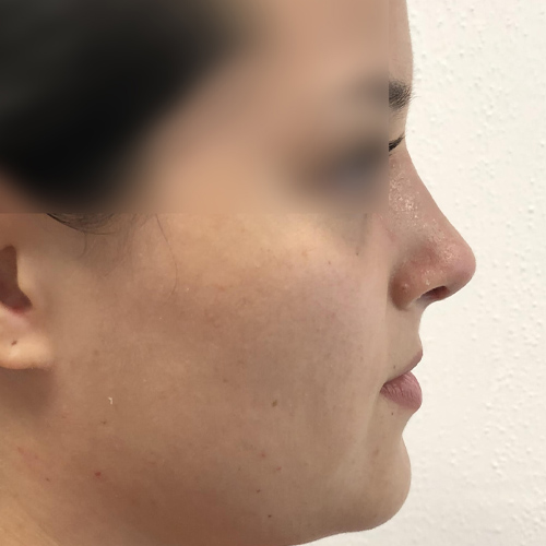 highprofile rinoplastia despues 1